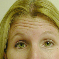 Frown lines before Botox injections
