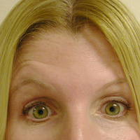 Frown lines after Botox injections