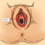 recurrent vaginismus vs. vestibulodynia
